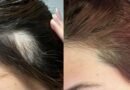 Thinning hair stopped shedding ‘almost instantly’ with growth serum