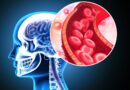 Stanford develops milli-spinner device for more effective stroke treatment