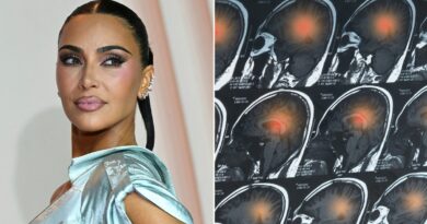 Doctors sound alarm after Kim Kardashian’s brain aneurysm revelation