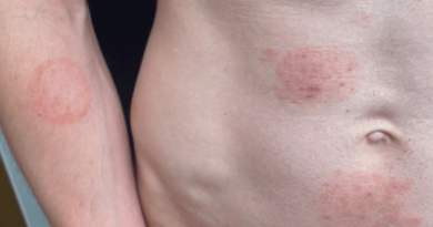 Sexually transmitted fungal infection outbreak hits Minnesota