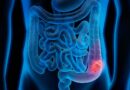 Virus in gut bacteria may be linked to colorectal cancer risk, study finds