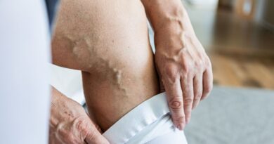 Doctor’s summer warning to Brits suffering from common issue
