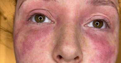Mum ‘gets her life back’ with ‘simple treatment’ for severe eczema Mum ‘gets her life back’ with ‘simple treatment’ for severe eczema