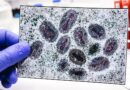 Connecticut confirms first clade I mpox case linked to travel in Europe
