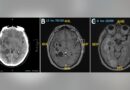 Brain cancer misdiagnosis turns out to be pork tapeworm infection