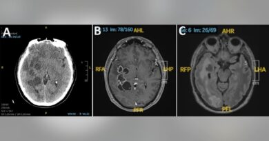 Brain cancer misdiagnosis turns out to be pork tapeworm infection