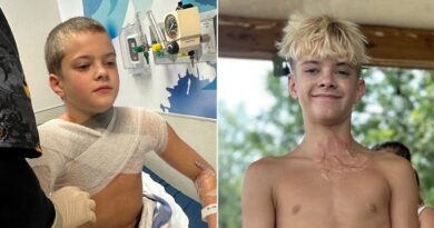Viral NeeDoh microwave trend leaves teen with third-degree burns