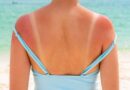 ‘Tanmaxxing’ trend, promoting more sun, raises concern among dermatologists