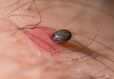 Horror as woman spends ‘6 weeks in coma’ after tick bite on holiday | World | News