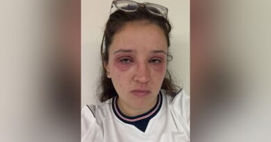 Bride gets severe allergic reaction to eyelash extensions before wedding