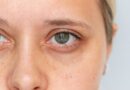 ‘Ferritin face’ trend links dark under-eye circles to low iron stores as doctors weigh in