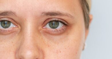 ‘Ferritin face’ trend links dark under-eye circles to low iron stores as doctors weigh in