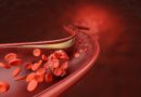 Early statins tied to 15% lower dementia risk in type 2 diabetes study