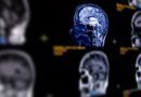 Menopause brain fog vs. dementia: How women can tell the difference